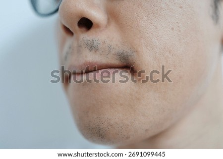 A man after five beard removal sessions. The patchy beard remaining around his mouth and chin.