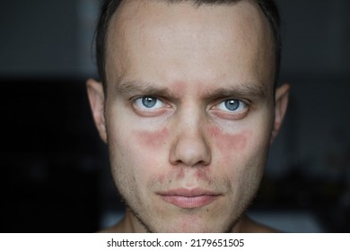 Man With Allergic Dermatitis, Red Spots On His Face. Autoimmune Disease Lupus.
