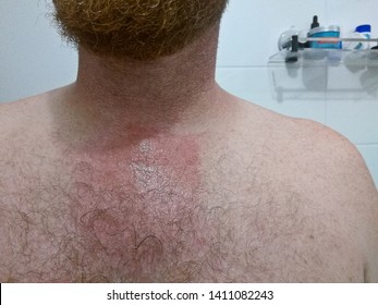 Man With Allergic Reactions From Bee Sting On The Chest. Photo Taken 3 Days After The Incident. Medical Treatment And Corticosteroid Cream Applied.