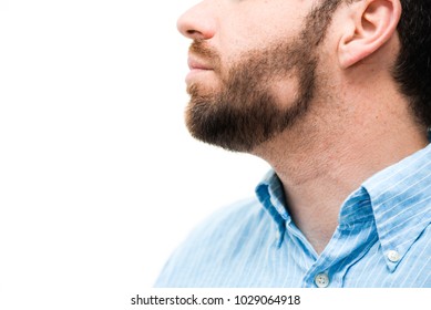 Man With Alopecia Areata In The Beard