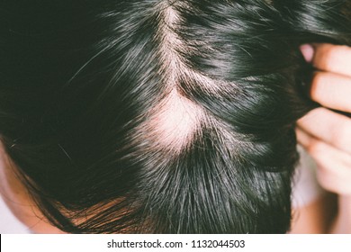 Royalty Free Bald Patch Stock Images Photos Vectors Shutterstock