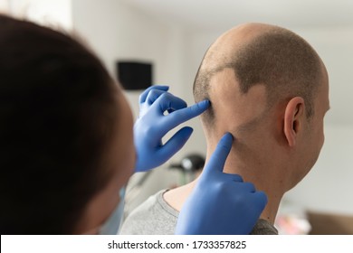 Man Alopecia Areata On Head Center Stock Photo 1733357825 | Shutterstock