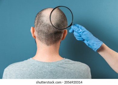 A man with alopecia on his head is being examined by a trichologist. The doctor's hand holds a magnifying glass at the center of baldness. Back view.  The concept of baldness and alopecia.