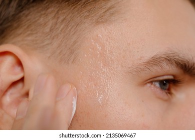 Man Applying Acne Cream On Face.Young Man Applying Cream For Problem Skin On Face, Closeup