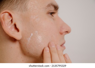 Man Applying Acne Cream On Face.Young Man Applying Cream For Problem Skin On Face, Closeup