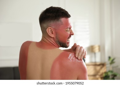 Man Applying Cream On Sunburn At Home, Back View