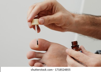 Man applying liquid on the wart of his foot. Home treatment of a veruca toe.