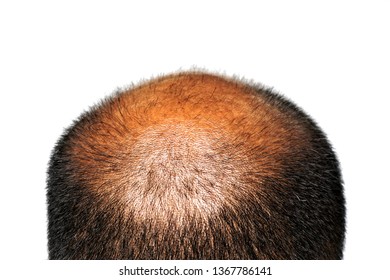 A Man Of Asia's Head With Thick Hair Around The Head. The Middle Head With Little Hair Quantity.