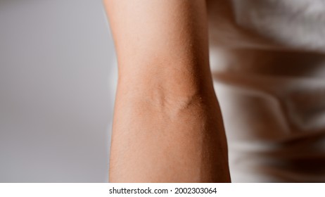 A Man With Atopic Dermatitis Scratching His Elbow