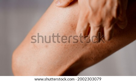 A man with atopic dermatitis scratching his thighs