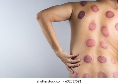 A Man Back With Blood Marks Massaged After Taking Chinese Cupping Therapy
