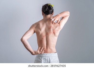 Man with back rash created using special effects makeup