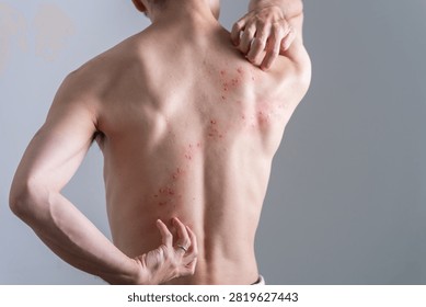 Man with back rash created using special effects makeup