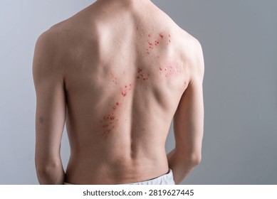 Man with back rash created using special effects makeup