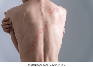 Man with back rash created using special effects makeup