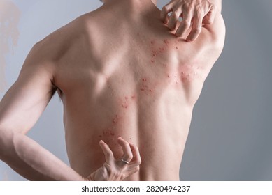 Man with back rash created using special effects makeup