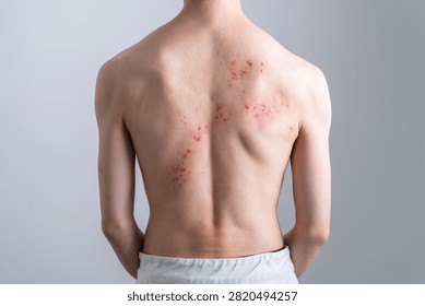 Man with back rash created using special effects makeup