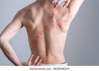 Man with back rash created using special effects makeup