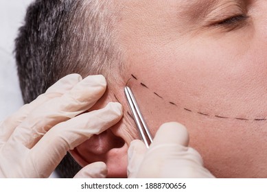 Man Beauty Procedure Beard Hair Implant For Senior Man