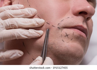 Man Beauty Procedure Beard Hair Implant For Senior Man