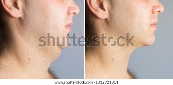 Man\
before and after double chin fat correction\
procedure
