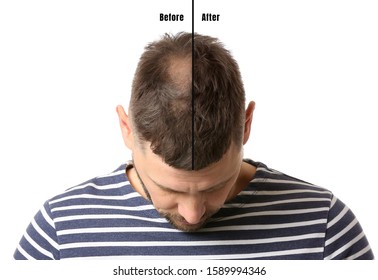 Man Before And After Hair Loss Treatment On White Background