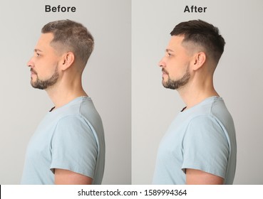 Man Before And After Hair Loss Treatment On Grey Background