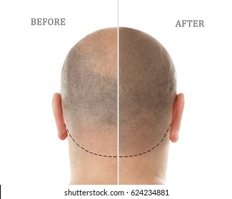 Man Before And After Hair Loss Treatment On White Background