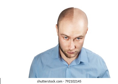 Man Before After Hair Loss Transplant Stock Photo 792102145 | Shutterstock