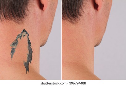 Man Before And After Laser Tattoo Removal Treatment