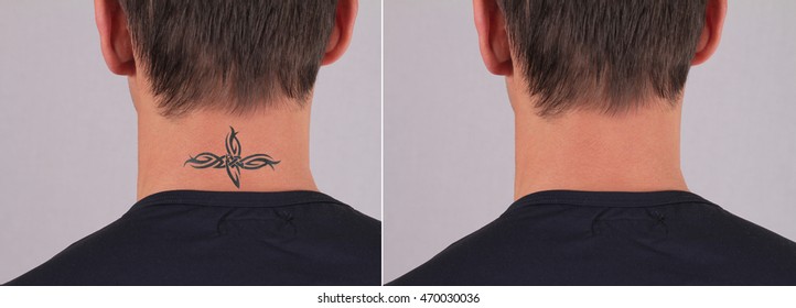 Man Before And After Laser Tattoo Removal Treatment