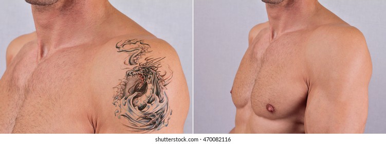 Man Before And After Laser Tattoo Removal Treatment