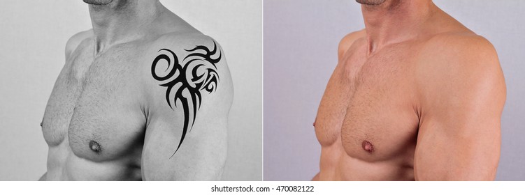 Man Before And After Laser Tattoo Removal Treatment