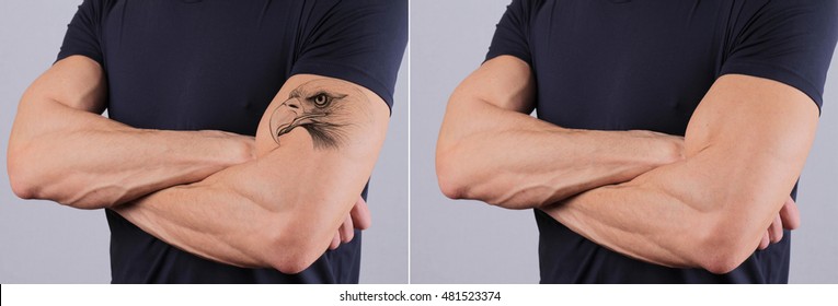 Man Before And After Laser Tattoo Removal Treatment