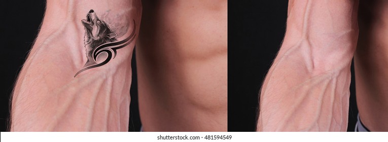 Man Before And After Laser Tattoo Removal Treatment