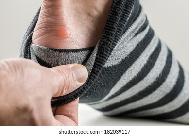 Man With A Blister On His Heel Lifting Down His Sock To Reveal The Raw Red Patch Of Rubbed Skin.