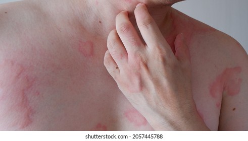 Man body suffering severe urticaria or hives or kaligata. Allergy symptoms.