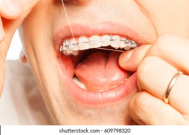 Man With Braces Clean Teeth Using Dental Floss 