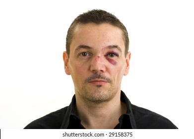 Man With Broken, Crooked Nose And Black Eye Isolated On White