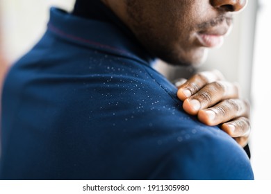 Man Brushing Dandruff From Dirty Suit. Itchy Head And Hair