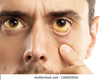Man checking his health condition. Yellowish eyes is sign of problems with liver, viral infection or other disease. - Shutterstock ID 1186032016