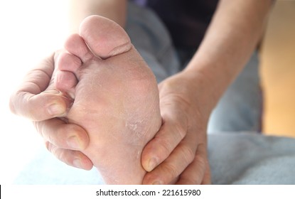 A Man Checks The Dry, Peeling Skin Of His Athletes Foot Fungus Between His Toes.