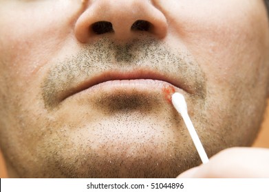 Man With  Cold Sore On His Lips