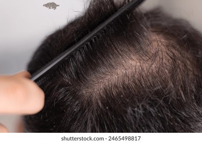 man concerned about hair loss, scalp problem, dandruff and dermatitis or eczema.young guy looking in mirror, use comb to show bald on top of head.isolated male on backdrop,space for text. - Powered by Shutterstock