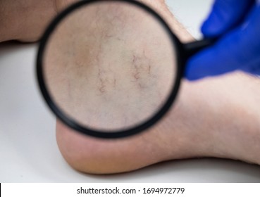 A Man In Consultation With A Vascular Surgeon. A Doctor Examines A Leg With Swollen Veins. Varicose Veins On The Leg