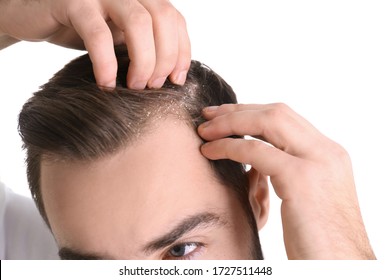 Man With Dandruff In His Hair On White Background, Closeup