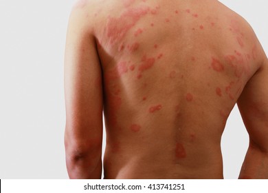 Man With Dermatitis Problem Of Rash ,Allergy Rash