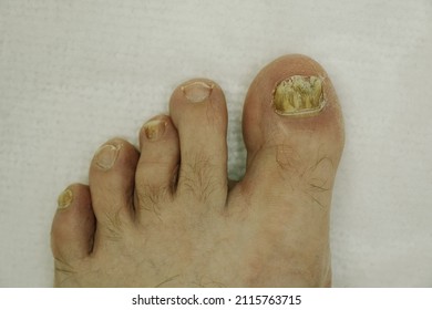 a man at a doctor's appointment, shows a toenail fungus
