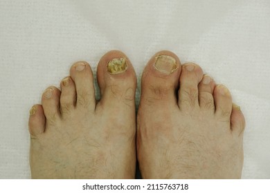 a man at a doctor's appointment, shows a toenail fungus