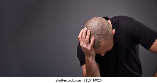 Man With Dry Flaky Skin On His Head With Psoriasis And Nail Fungus On Hands. Autoimmune Genetic Disease.